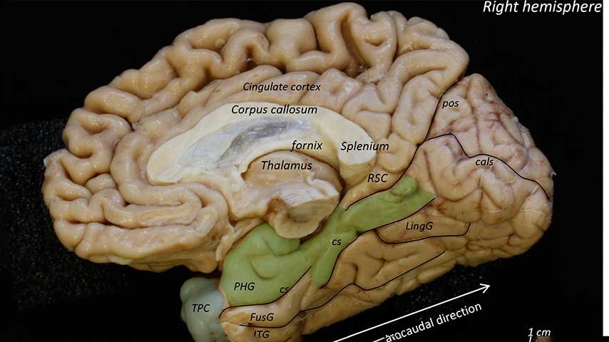 Estudio_ALzheimer_Insausti-(002)